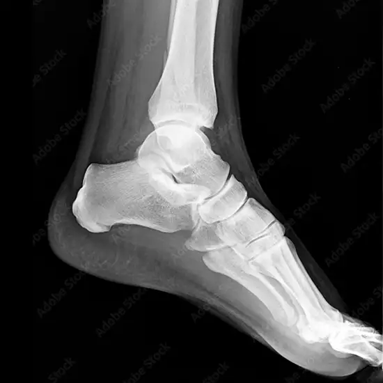 MRI Left Foot
